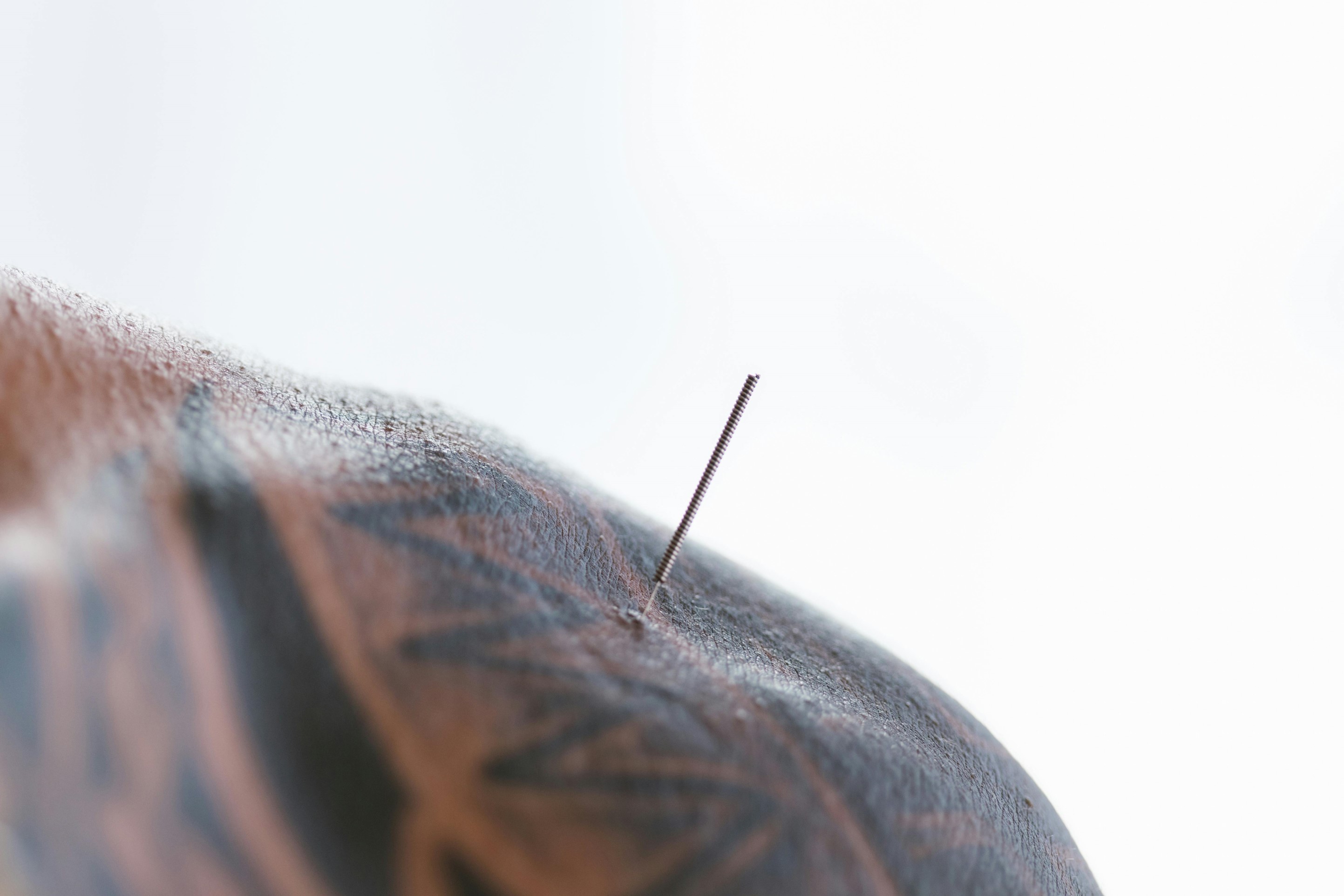 Acupuncture Treatment